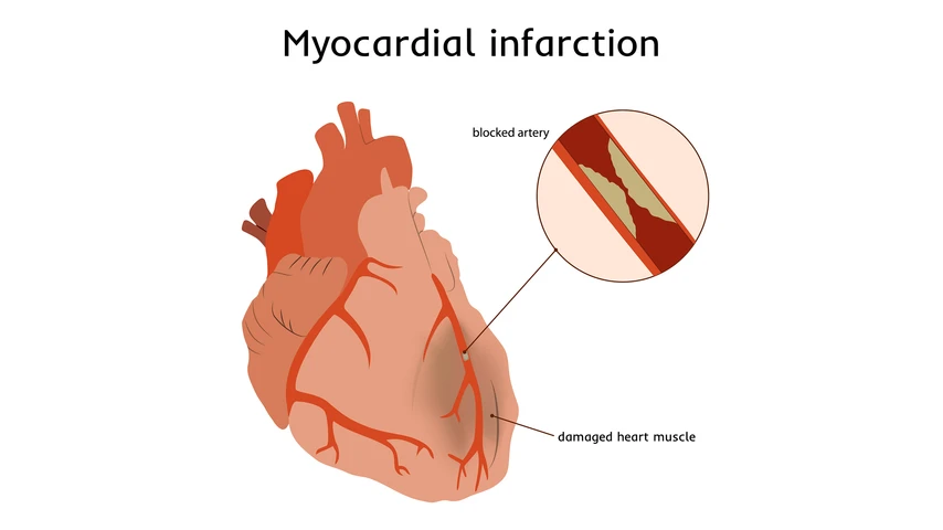 Acute Myocardial Infarction